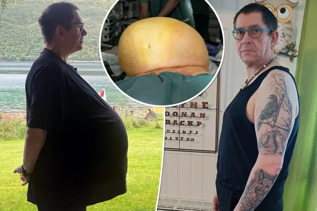 Artsen vinden tumor van 27 kilo in buik van man die jarenlang werd weggezet als ’te zwaar’