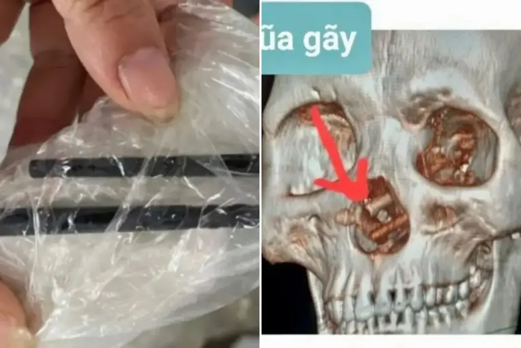 Man ontdekt na vijf maanden hoofdpijn dat er eetstokjes in zijn hersenen zaten