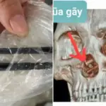 Man ontdekt na vijf maanden hoofdpijn dat er eetstokjes in zijn hersenen zaten