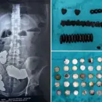 Krachtsporter eet 39 munten en 37 magneten om zogenaamd zink op te nemen: artsen waarschuwen