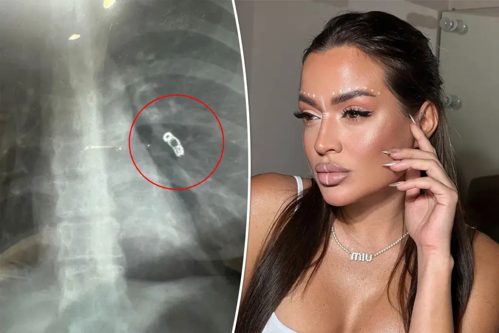 Influencer dacht aan verkoudheid — röntgenfoto onthult achtergelaten metalen veer in haar longen