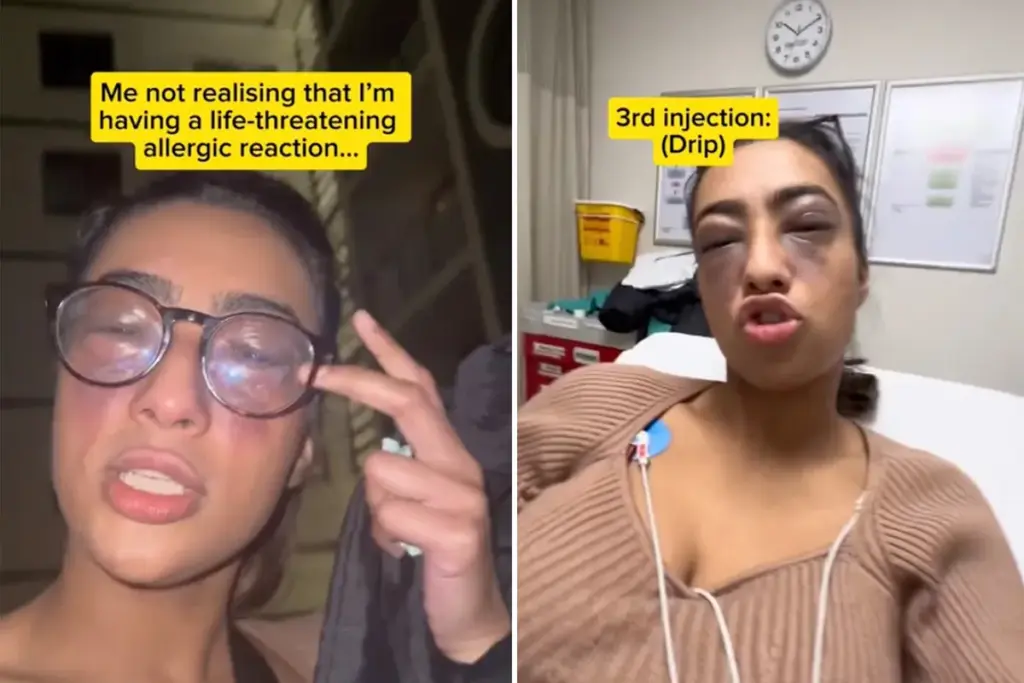 Influencer negeert EpiPen en filmt levensbedreigende allergische reactie voor TikTok
