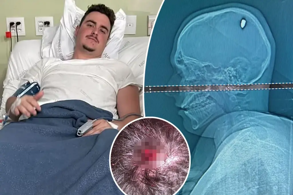 Braziliaanse student feest vier dagen met kogel in hoofd, denkt geraakt te zijn door steen